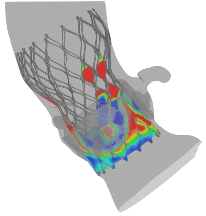  In the above Abaqus FEA image, the blue shading represents good apposition, and the red incomplete apposition. TAVIguide simulations allow physicians to evaluate the effect of size and positioning of stent-supported valves in their patient’s anatomies. 