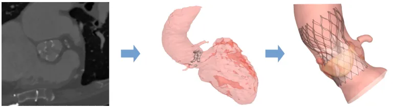 The images above represent the progression of the TAVIguide process. On the far left is a patient’s pre-operative CT image, which is then used to create a 3D reconstruction (center). At right is a simulation of TAVI in this specific patient’s anatomy. 